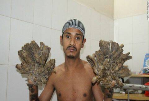 Τον θυμάστε τον άνθρωπο-δέντρο από το Μπαγκλαντές; Δείτε πώς είναι σήμερα, μετά την χειρουργική επέμβαση (Photos)