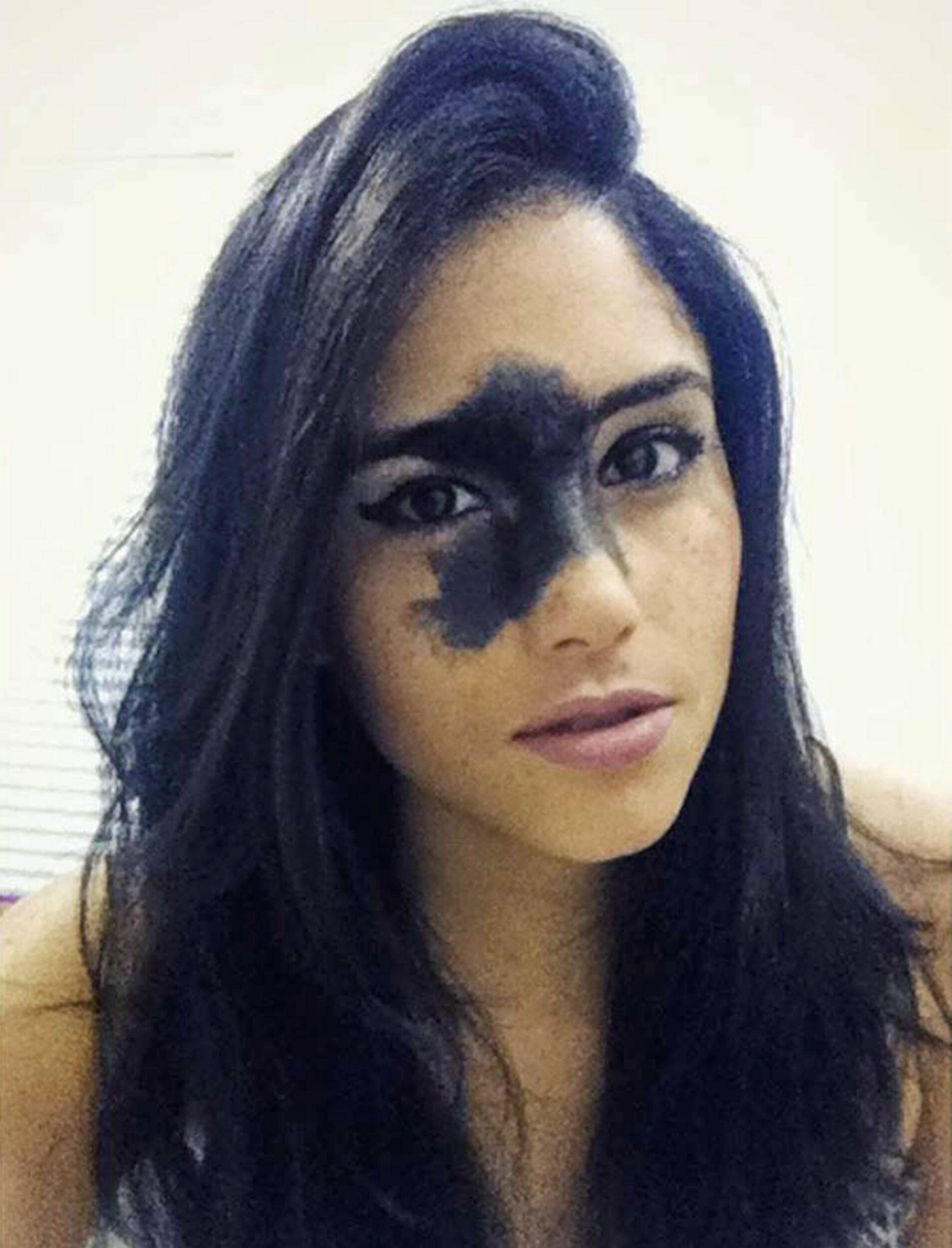 Model says facial birthmark makes her unique and refuses to be embarrassed