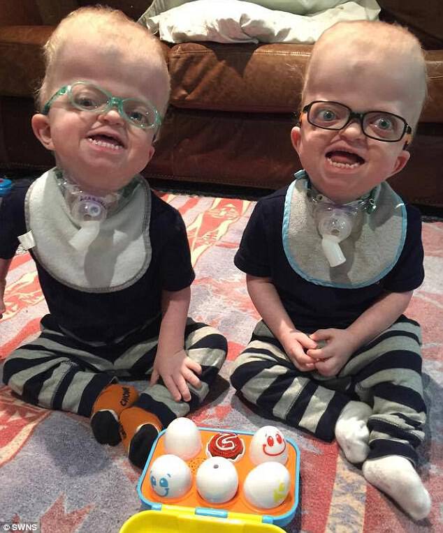 Look at those smiles! The twins have both had three operations over the last two years to reshape their head structure and allow space for their brains to grow