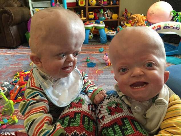 Play time! Twins Matthew and Marshall inherited the rare genetic disorder, which affects their head and skull, from their father
