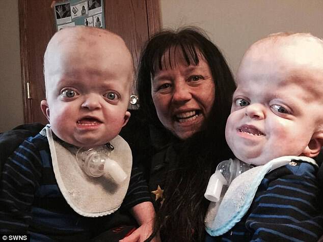 Say cheese! The twins were born with Pfeiffer Syndrome, a rare genetic disorder that causes their heads to be misshapen and oversized 