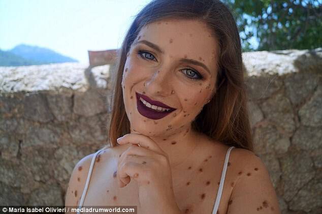 Maria Isabel Olivieri, 22, from Palma, Spain, has described how she has come to love her body after being born with birthmarks all over her skin
