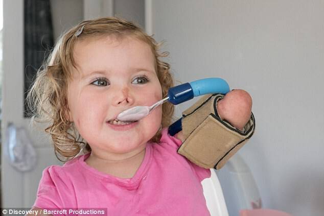 Harmonie-Rose Allen, of Bath, contracted Meningitis B when she was 10 months old. She has now been fitted with prosthetic limbs to aid her growth