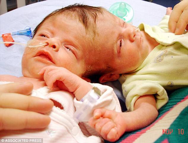Uncertain: When the twins were born, doctors thought they might not survive the day