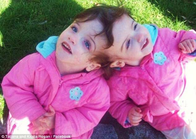 Not only do the twins see through one another's eyes, they also share emotions and feel it when the other is tickled