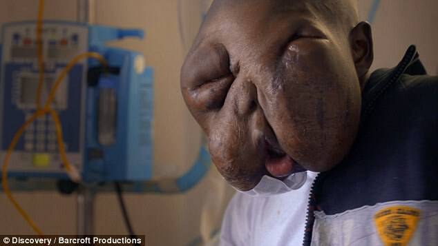His father could not afford untreated and the lump grew to completely swallow up his face 