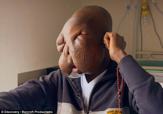 Kambou Sie was abandoned by his mother who 'couldn't cope' with his facial disfigurement