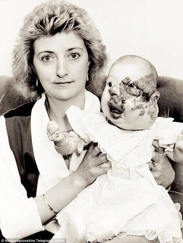 At birth, the left side of her face was distorted by the mark (pictured with her mother Theresa)