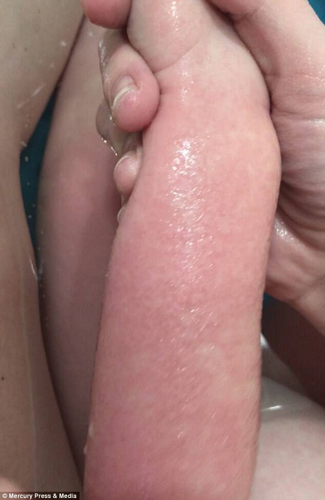 Any water exposure causes the youngster to develop agonising hives across her body