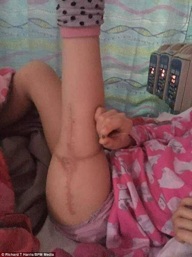 Surgeons at the Royal Orthopaedic Hospital used a rare procedure called rotationplasty in which Amelia's leg was amputated high up her thigh, then the lower leg reattached the wrong way around, allowing the ankle to function as a knee