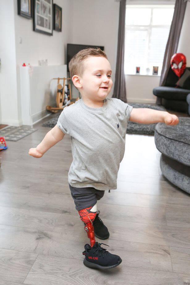 3χρονος που έχασε τα πόδια του από μηνιγγίτιδα έκανε τα πρώτα του βήματα με προσθετικά άκρα - Εικόνα 2