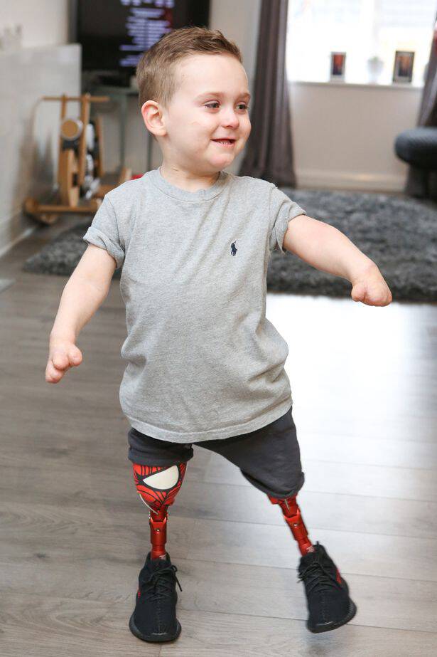3χρονος που έχασε τα πόδια του από μηνιγγίτιδα έκανε τα πρώτα του βήματα με προσθετικά άκρα - Εικόνα 4