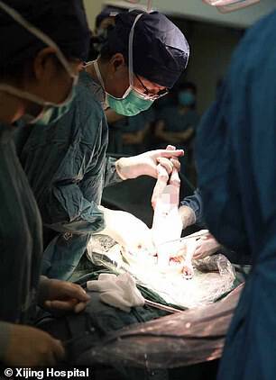 TheÂ C-section lasted just over an hour and the woman was 33 weeks and six days pregnant