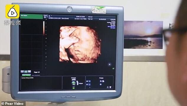 Ms Yang became pregnant in June last year on the fifth attempt at implanting an embryo fertilised through IVF. A doctor is pictured looking at the ultrasound scan of the unborn boy