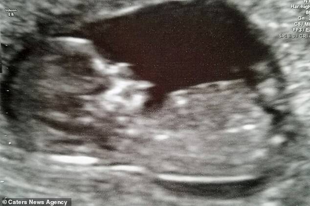 Mrs Barone - who conceived naturally after four-and-a-half years of fertility treatment - was told at her six-month ultrasound scan (pictured) she had dangerously high blood pressure, and her kidneys and liver were failing. Mikey therefore had to be born at 25 weeks via C-section