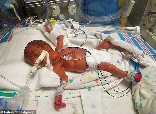Pictured as a newborn, medics warned Mikey's parents he would have a poor quality of lifeÂ 