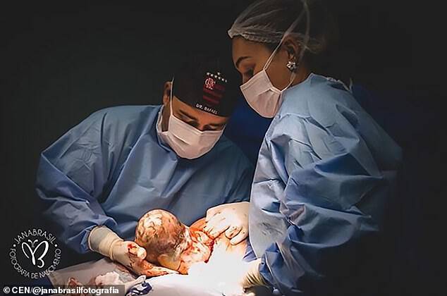 Unusual labour: The amniotic sac fails to burst in a one-in-100,000 rare occurrence
