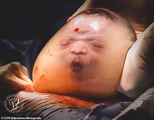 Rare: The newborn baby, named Noah by mother Monyck Valasco, can still be seen inside the amniotic sac after he is bornÂ at the Praia da Costa Hospital in the city of Vila Velha, Brazil