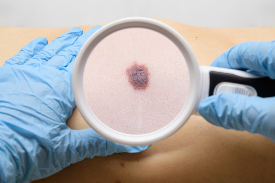 Mole-melanoma-skin-cancer